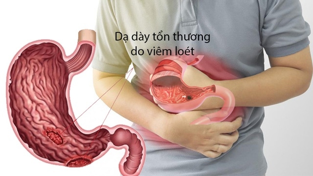 Thức ăn cay kích thích vị giác nhưng có thể làm trầm trọng thêm tình trạng bệnh lý nào?