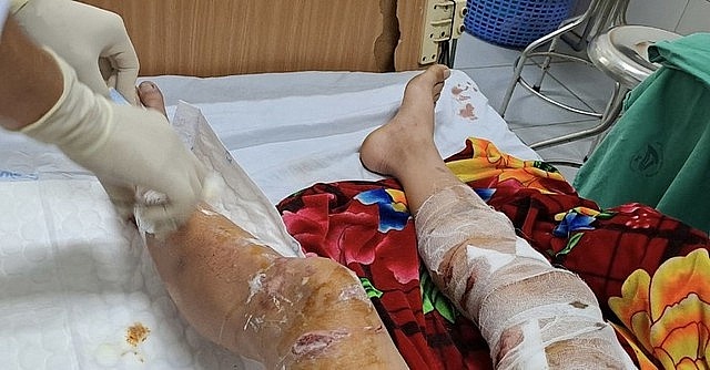 Bác sĩ thông tin về sức khỏe nam sinh bị 2 chó dữ tấn công khi đang đi đường