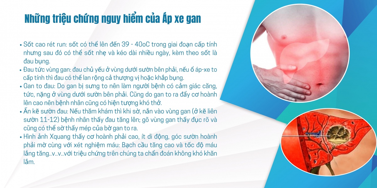 Hai thói quen tưởng vô hại khiến nhiều người nhập viện vì áp xe gan