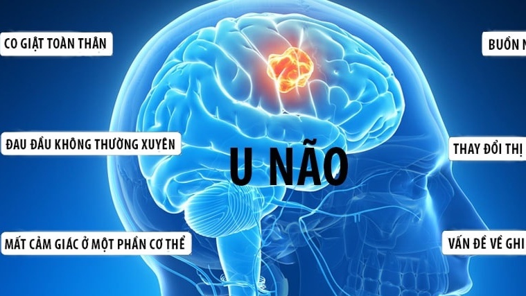 Sau sự ra đi của diễn viên Quý Bình: Hiểu rõ về căn bệnh u não và cách phòng ngừa