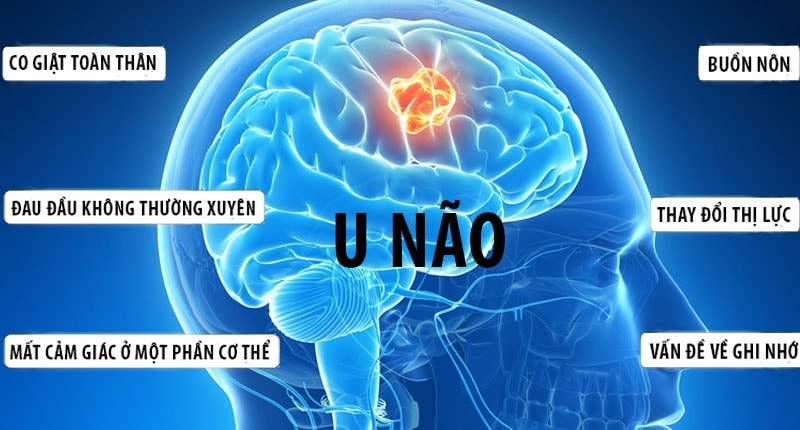 Sau sự ra đi của diễn viên Quý Bình: Hiểu rõ về căn bệnh u não và cách phòng ngừa