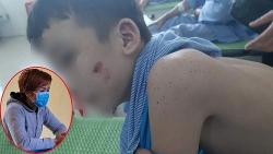 Vụ cậu bé bị bạo hành đến mức phải bỏ trốn: Vết thương không chỉ nằm ở ngoài da